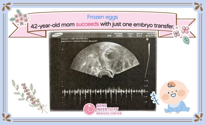 Advance Egg Freezing, One Transfer Pregnancy Success at 42